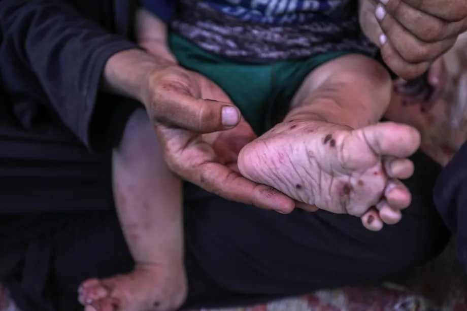 Tak Ada Susu dan Obat-obatan, Kulit Bayi Gaza Melepuh