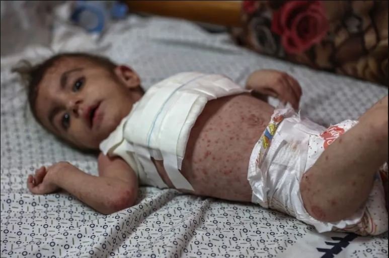 MSF: Fasilitas Kesehatan Gaza Hidup Segan Mati Tak Mau